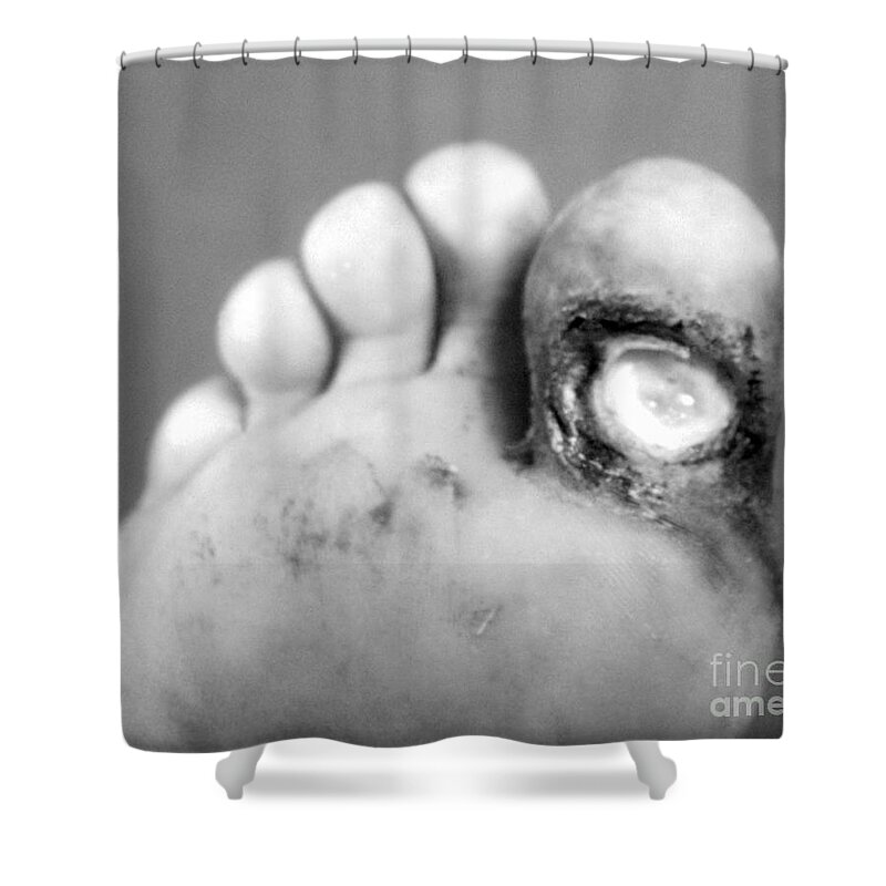 Bacterial Shower Curtain featuring the photograph Syphilis Ulcer by Science Source