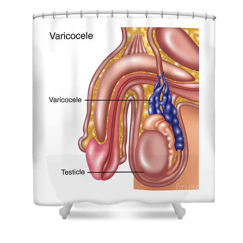 Medical Shower Curtain featuring the photograph Scrotal Varicocele, Illustration #1 by Gwen Shockey