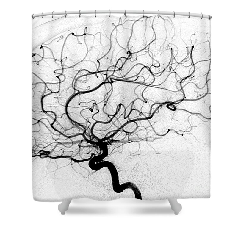 Cerebral Angiogram Shower Curtain featuring the photograph Dural Arterial Venous Fistula, Angiogram by Living Art Enterprises