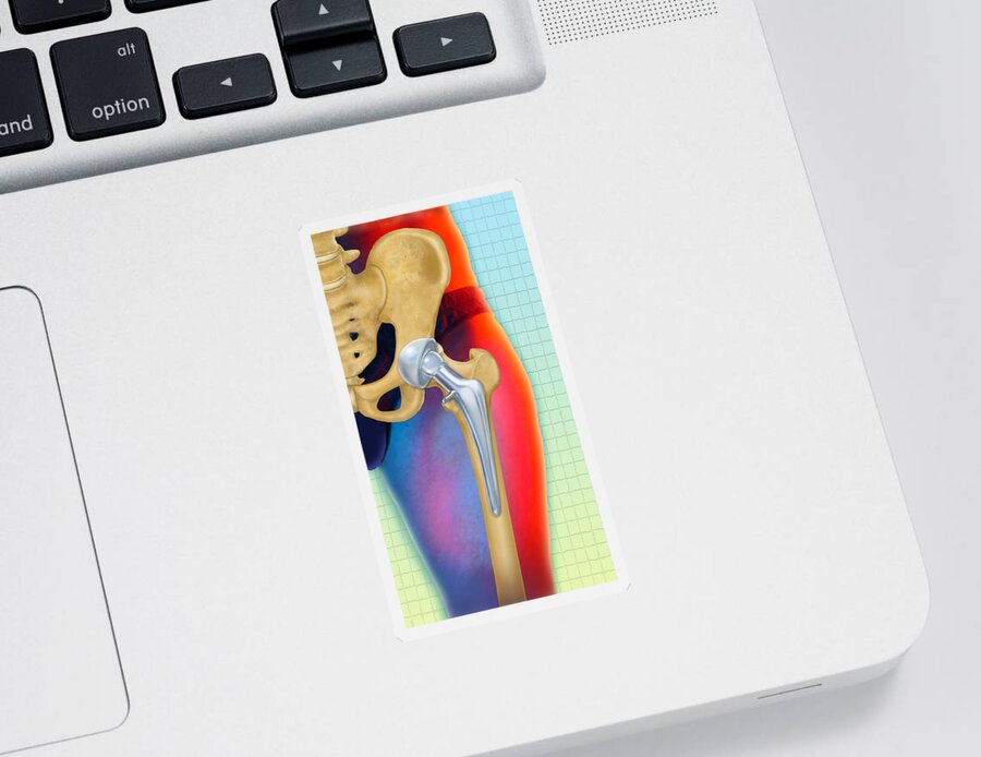 Art Sticker featuring the photograph Prosthetic Hip Replacement by Chris Bjornberg