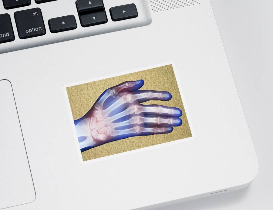 Arthritic Sticker featuring the photograph X-ray, Rheumatoid Arthritis #1 by Chris Bjornberg