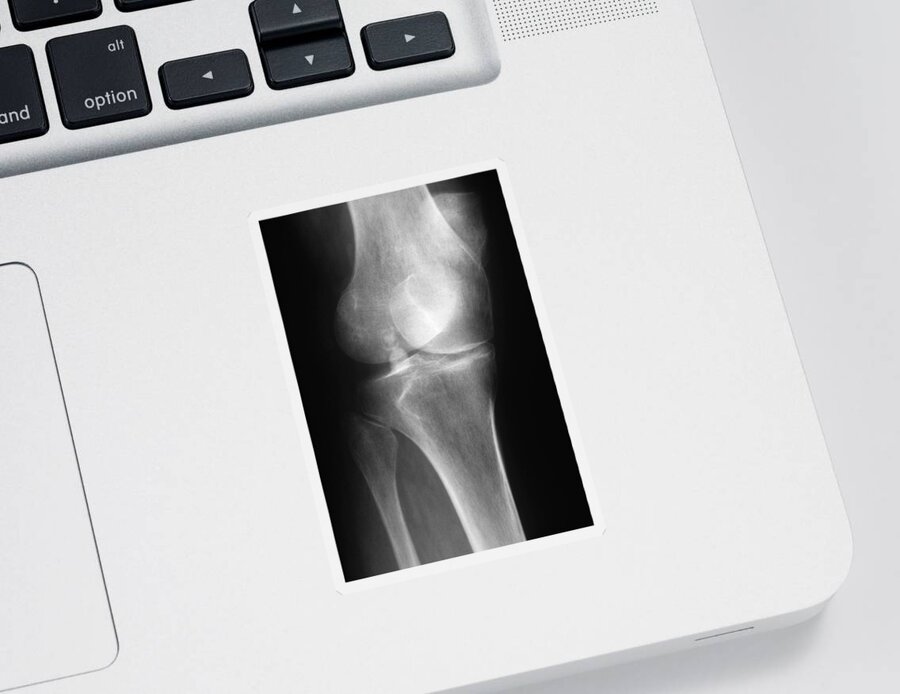 Abnormal Sticker featuring the photograph Arthritic Knee, X-ray #2 by Chris Bjornberg
