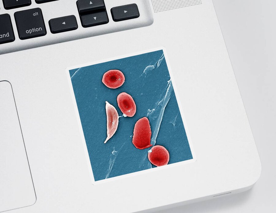 Science Sticker featuring the photograph Sickle Cell Anemia, Human Rbcs, Sem #2 by Science Source