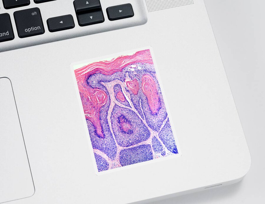 Squamous In Situ Sticker featuring the photograph Skin Cancer, Bowens Disease, Lm by Garry DeLong