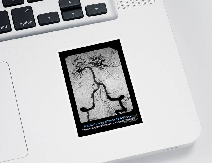 Cerebral Sticker featuring the photograph Cerebral Angiogram #1 by Medical Body Scans