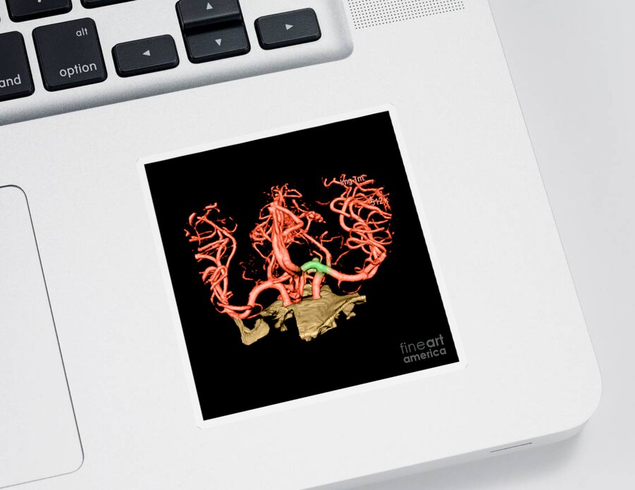 Abnormal Cerebral Blood Vessel Sticker featuring the photograph Ct Angiogram Of Aneurysm #1 by Medical Body Scans