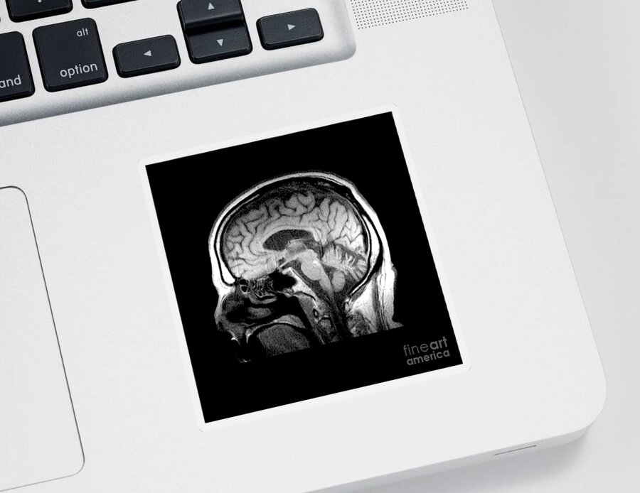 Mri Of Brain Sticker featuring the photograph Mri Of Alcoholism Related Vermian #1 by Medical Body Scans