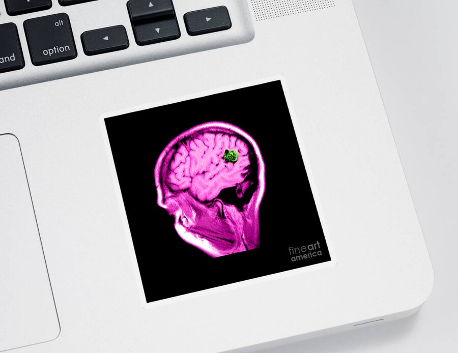Abnormal Cerebral Blood Vessels Sticker featuring the photograph Mri Of Brain Avm #1 by Medical Body Scans