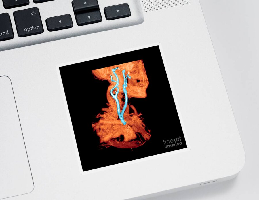 3 Dimensional Sticker featuring the photograph 3d Cta Of Carotid Arteries #2 by Medical Body Scans