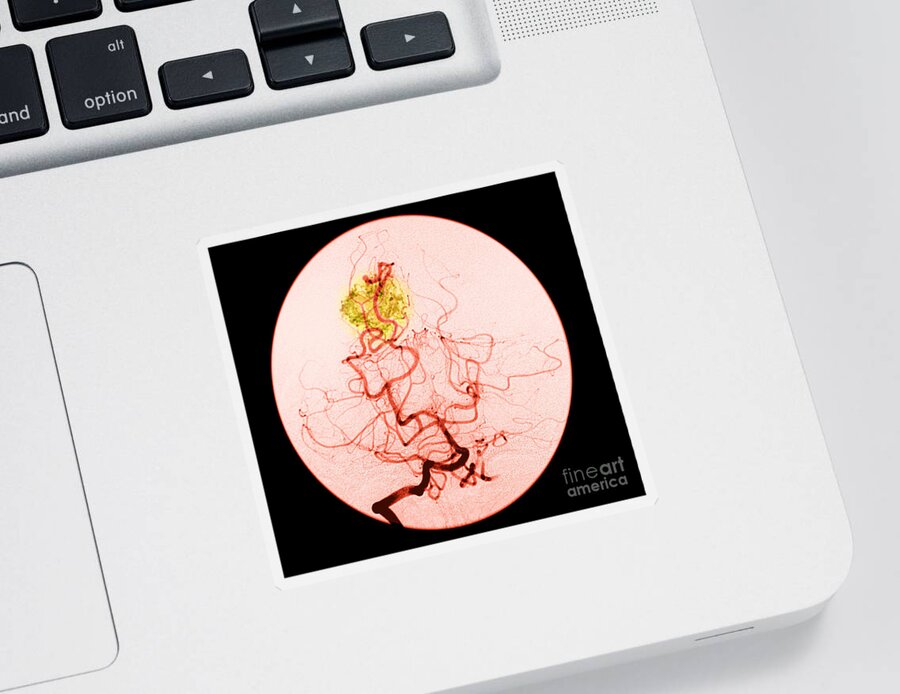Abnormal Cerebral Angiogram Sticker featuring the photograph Occipital Lobe Avm #2 by Medical Body Scans
