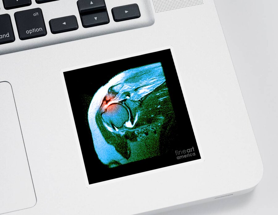 Magnetic Resonance Imaging Sticker featuring the photograph Rotator Cuff Tear #2 by Medical Body Scans