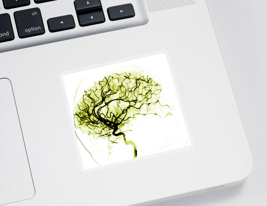 Catheter Cerebral Angiogram Sticker featuring the photograph Cerebral Angiogram #3 by Medical Body Scans