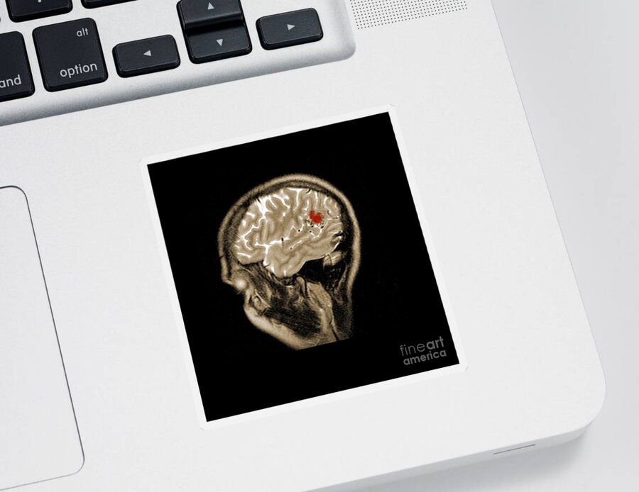 Abnormal Sticker featuring the photograph Mri Of Brain Avm #3 by Medical Body Scans