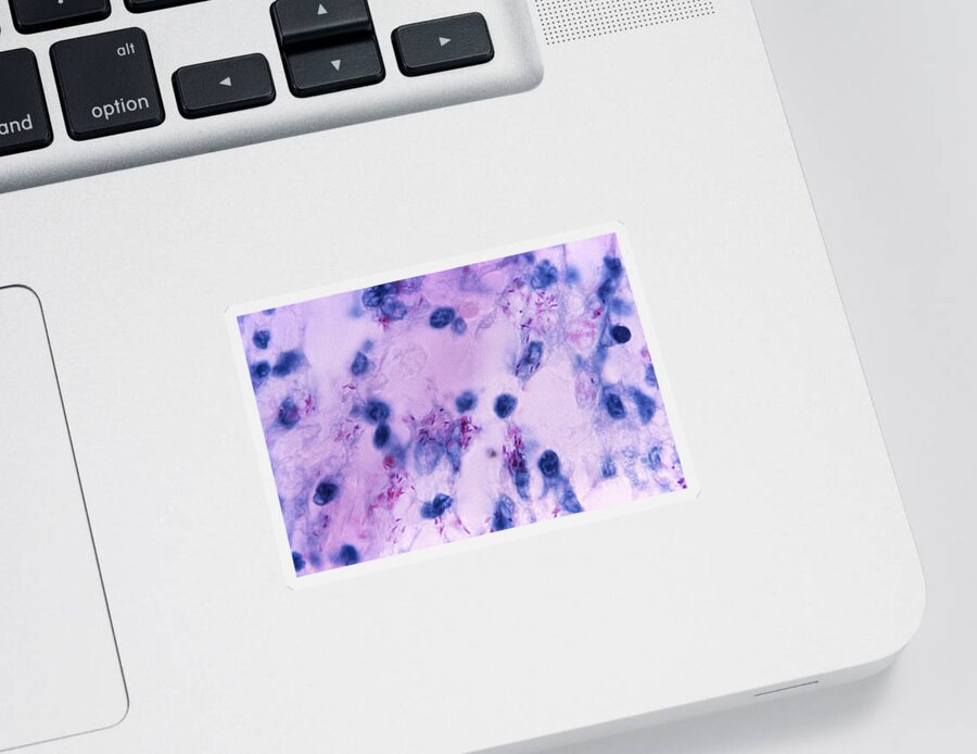 Science Sticker featuring the photograph Mycobacterial Skin Infection #3 by Science Source