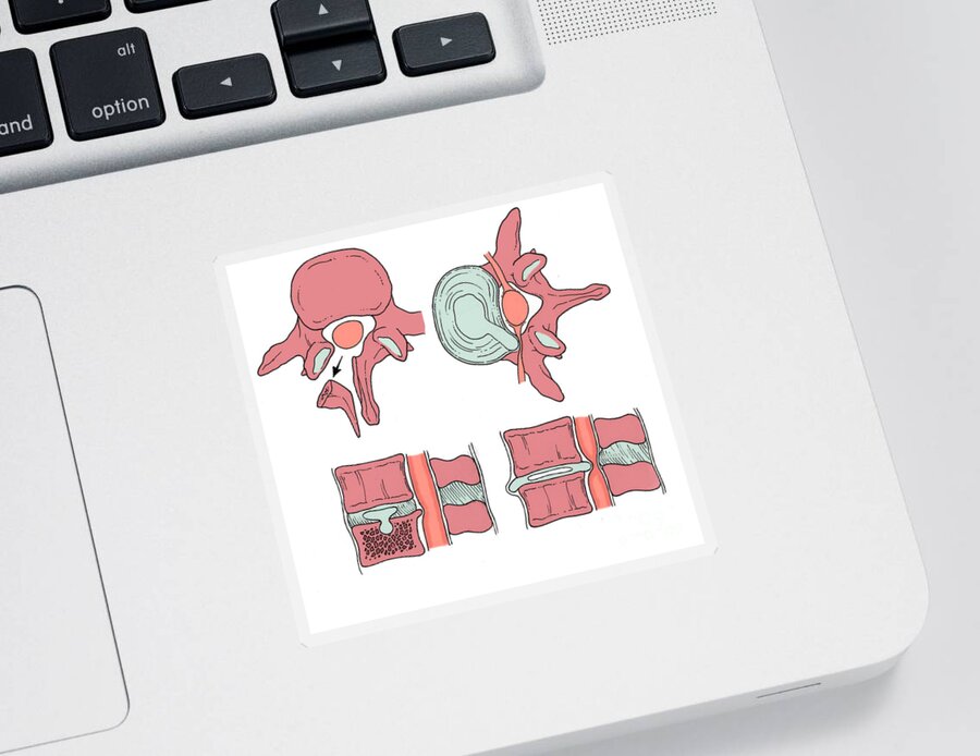 Anatomy Sticker featuring the photograph Illustration Of Spinal Disk Pathologies #4 by Science Source