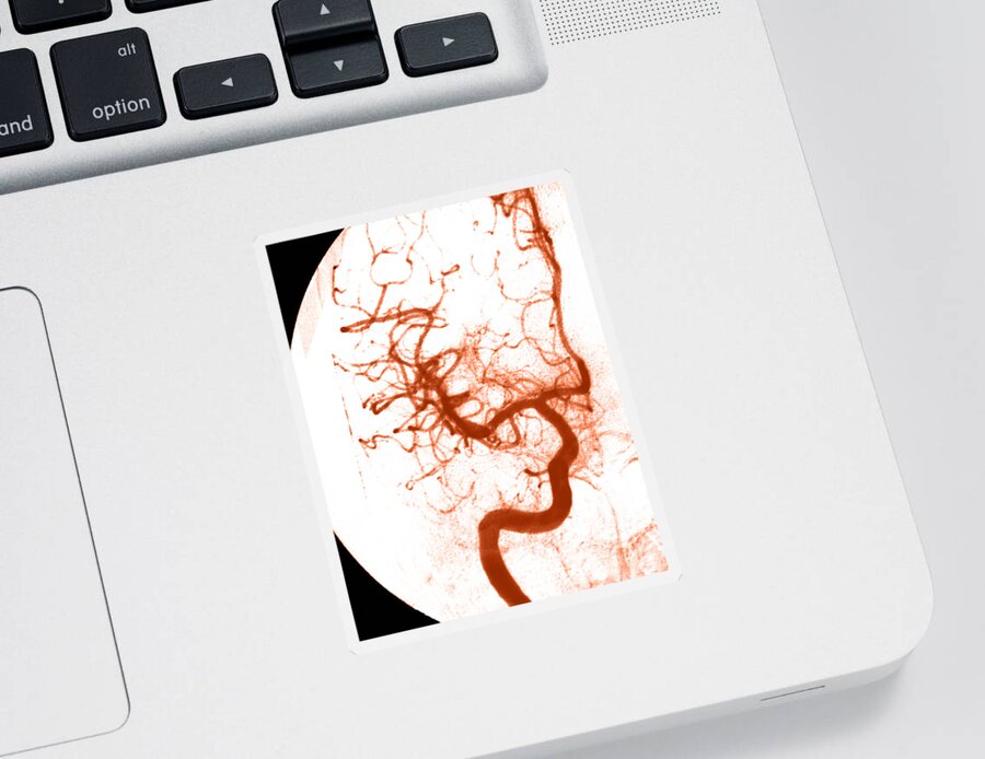 Angiogram Sticker featuring the photograph Cerebral Angiogram #9 by Medical Body Scans