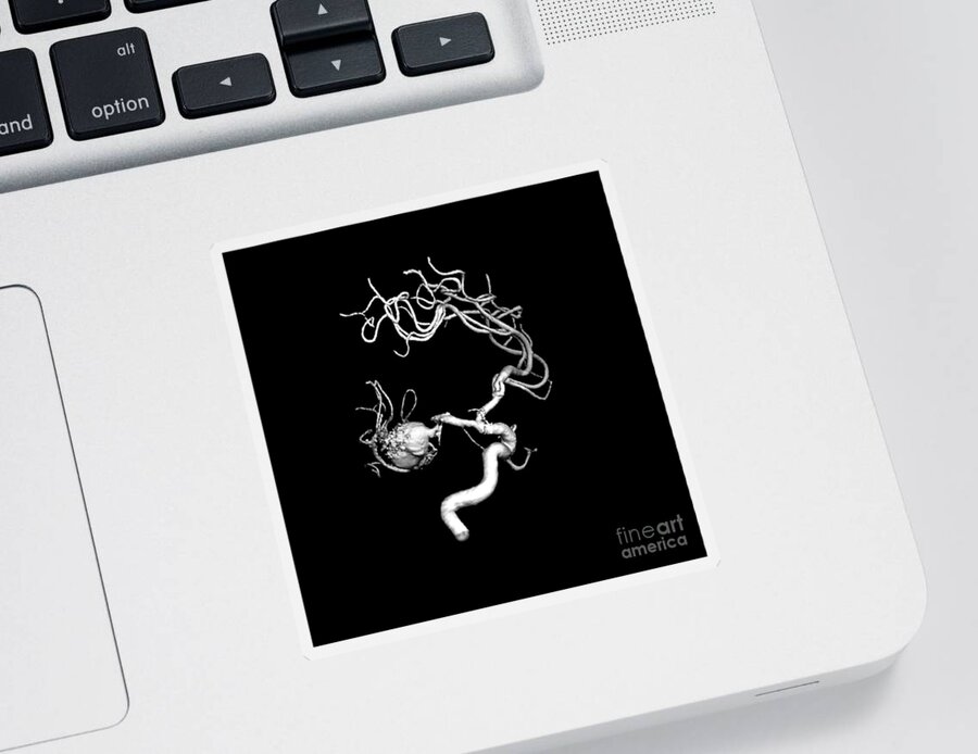 X-ray Sticker featuring the photograph Aneurysm In The Human Brain by Medical Body Scans