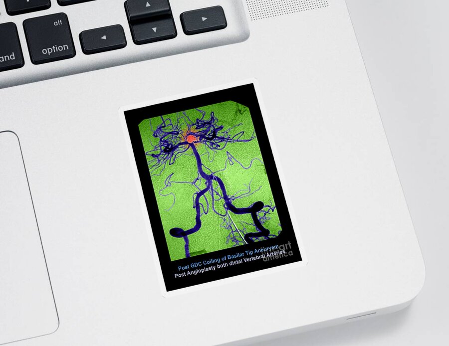 Abnormal Blood Vessel Sticker featuring the photograph Cerebral Angiogram by Medical Body Scans