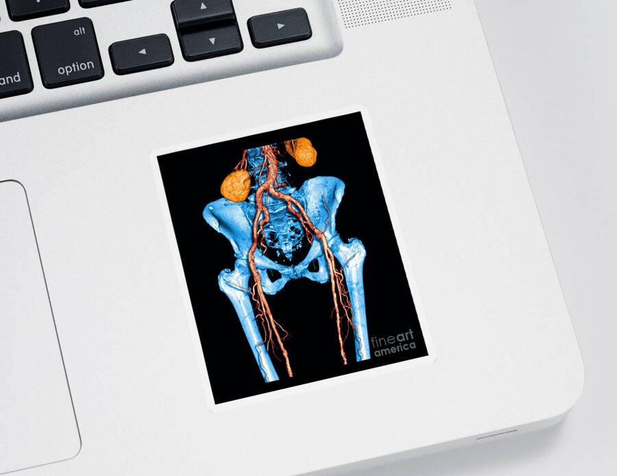 Anatomy Sticker featuring the photograph Pelvis And Upper Legs by Medical Body Scans