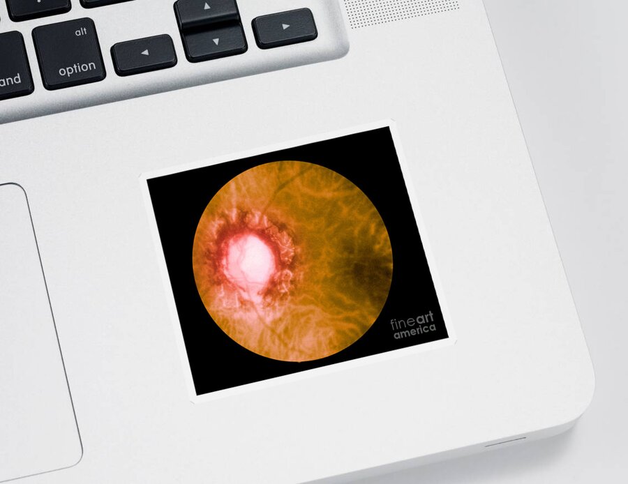 Bacteria Sticker featuring the photograph Retina Infected By Syphilis by Science Source