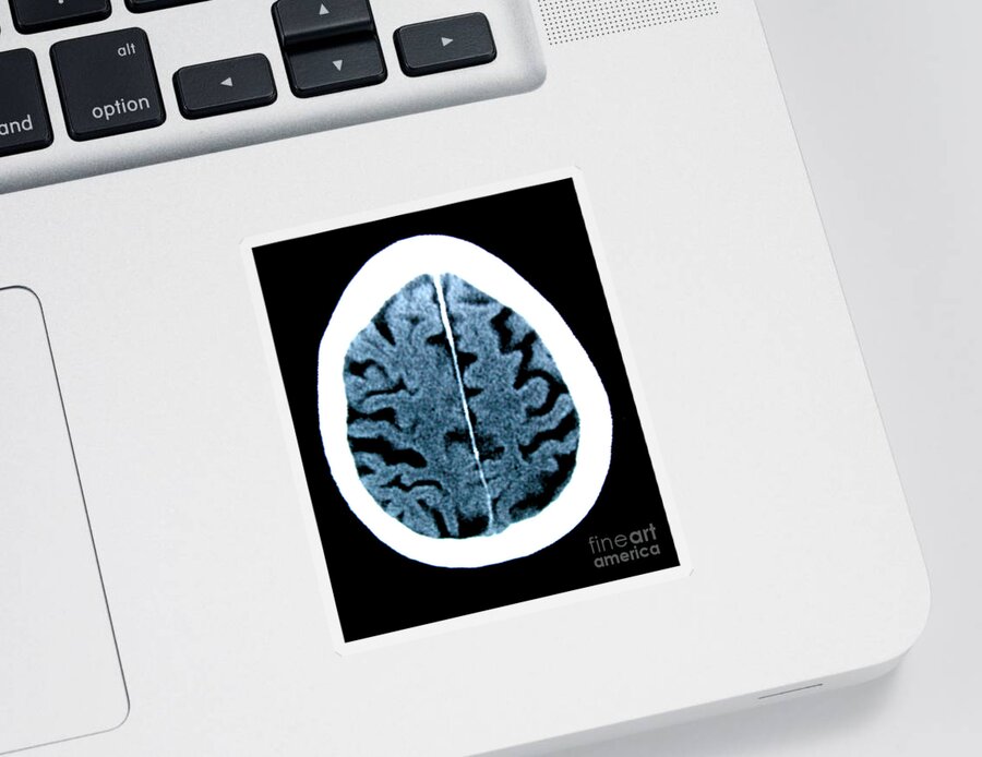 Radiology Sticker featuring the photograph Brain Of Alzheimers Patient, Ct Scan #1 by Scott Camazine