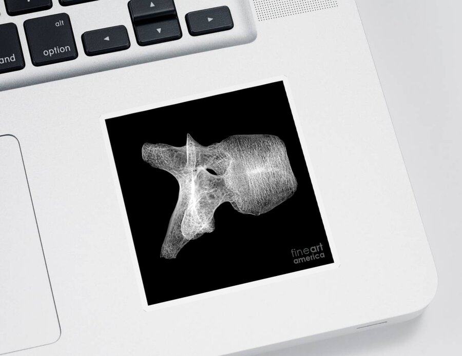 Science Sticker featuring the photograph Human Vertebra T5, X-ray #7 by Ted Kinsman