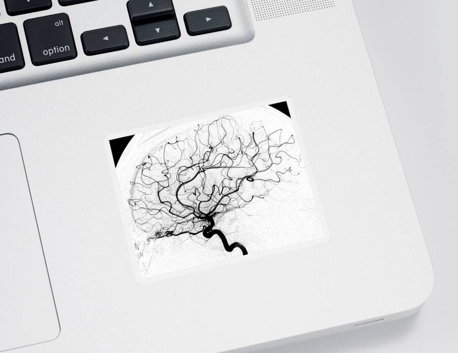 Cerebral Angiogram Sticker featuring the photograph Dural Arterial Venous Fistula, Angiogram by Living Art Enterprises