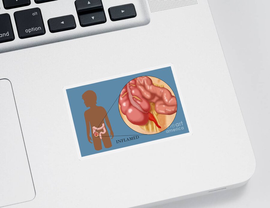Anatomy Sticker featuring the photograph Inflamed Appendix by Monica Schroeder