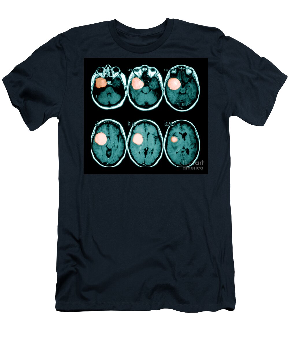Mri T-Shirt featuring the photograph Brain Tumor by Medical Body Scans