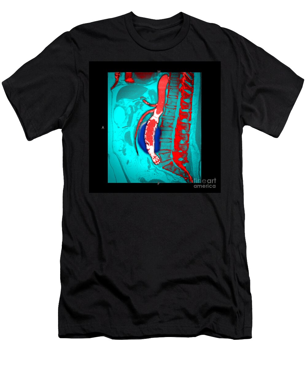 Science T-Shirt featuring the photograph Abdominal Stent Graft #1 by Living Art Enterprises