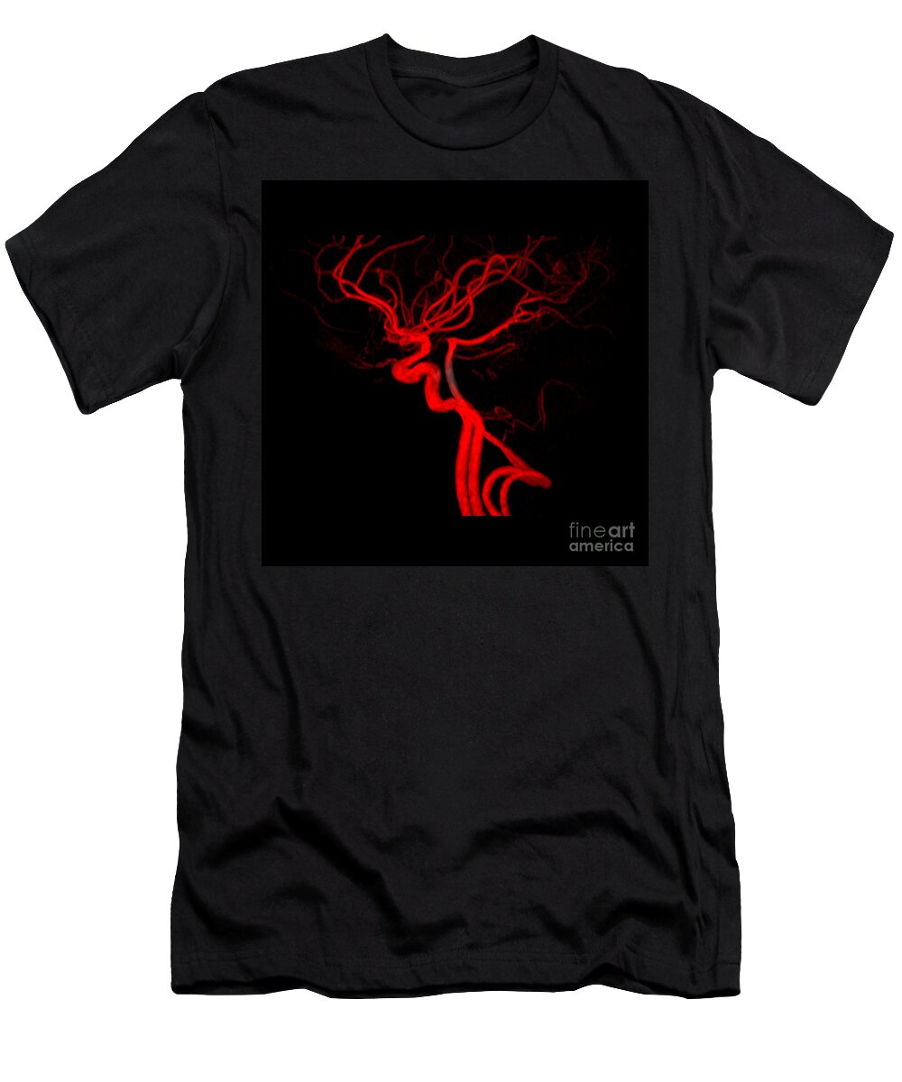 Intracranial Mra T-Shirt featuring the photograph Normal Intracranial Mra #2 by Living Art Enterprises