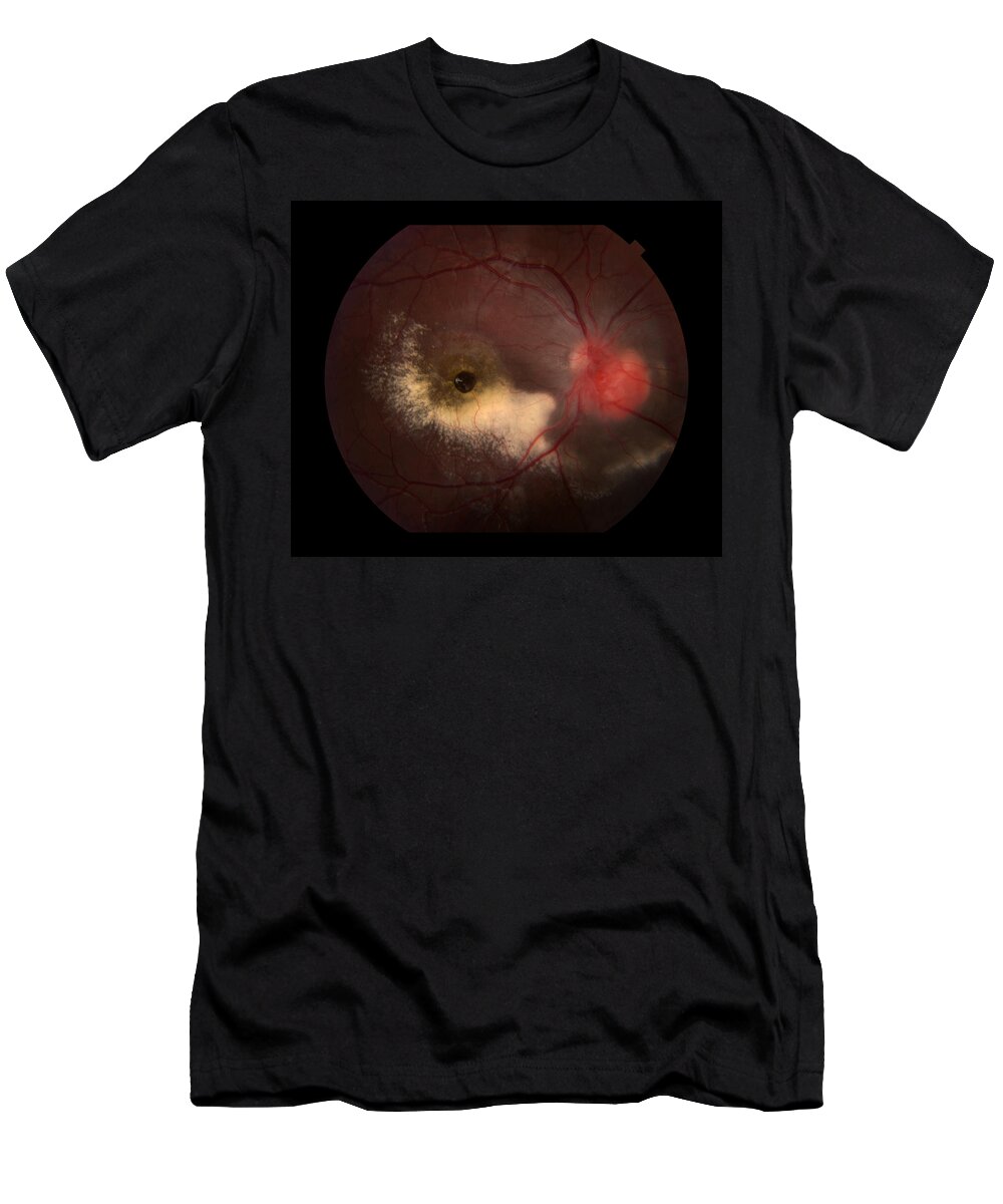 Abnormal T-Shirt featuring the photograph Capillary Hemangioma, 1 Of 2 by Paul Whitten