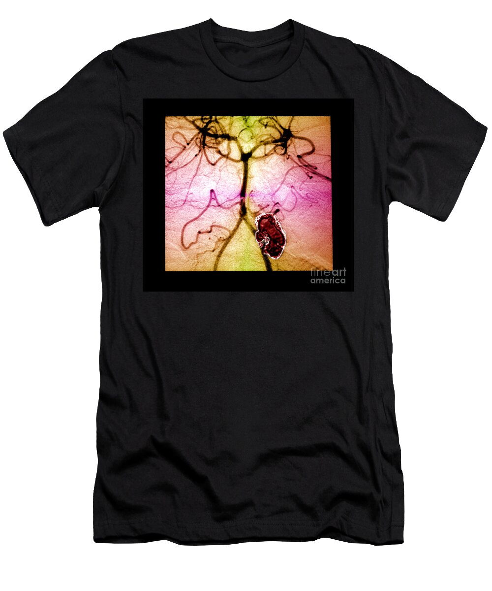 Cerebral Angiogram T-Shirt featuring the photograph Rupturing Brain Aneurysm by Living Art Enterprises
