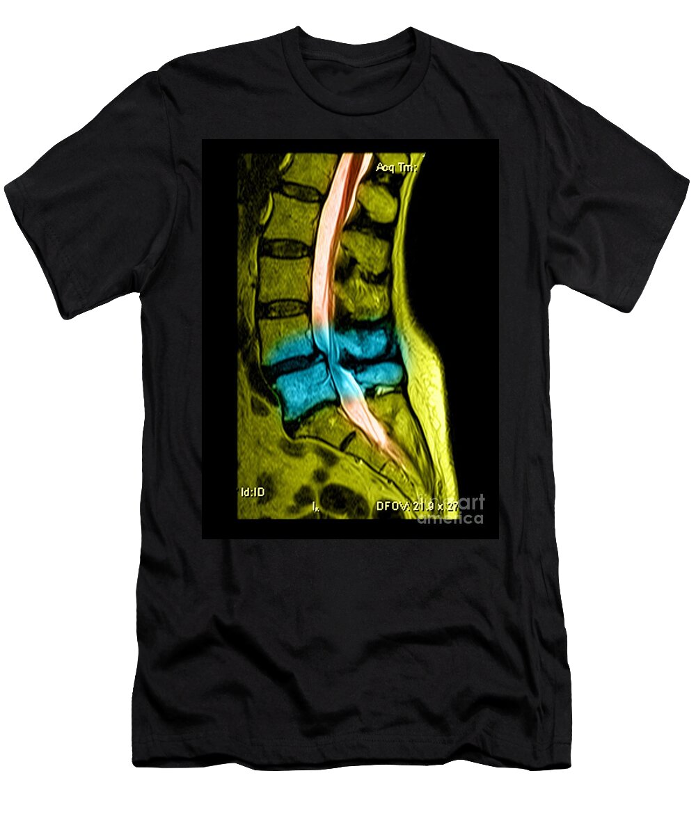 Anatomy T-Shirt featuring the photograph Spondylolisthesis and Canal Stenosis by Medical Body Scans
