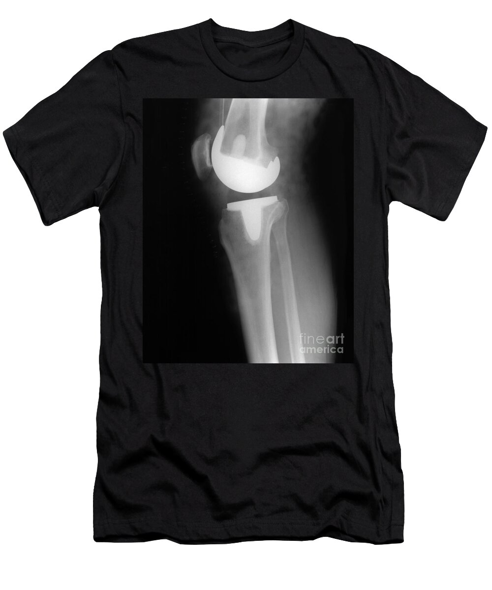 Xray T-Shirt featuring the photograph Knee Replacement X-ray by Ted Kinsman