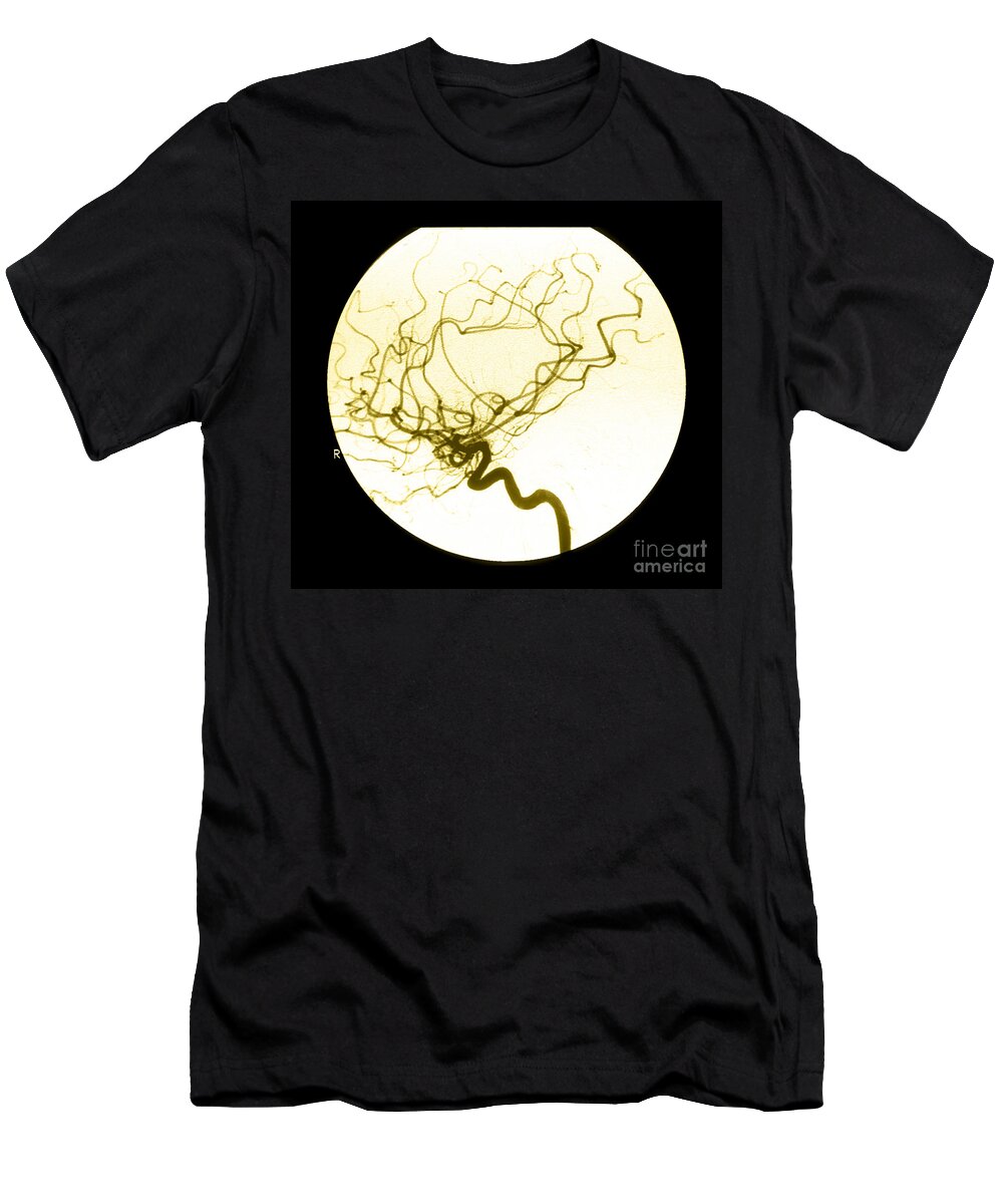 Cerebral Angiogram T-Shirt featuring the photograph Internal Carotid Cerebral Angiogram by Medical Body Scans