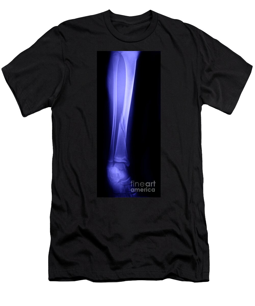 Xray T-Shirt featuring the photograph X-ray Of Fractured Tibia by Ted Kinsman