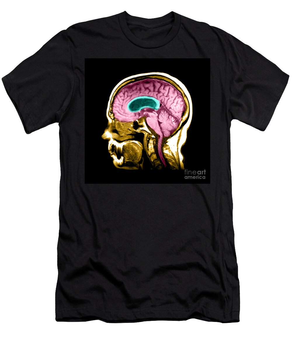 Brain T-Shirt featuring the photograph Hydrocephalus #3 by Medical Body Scans