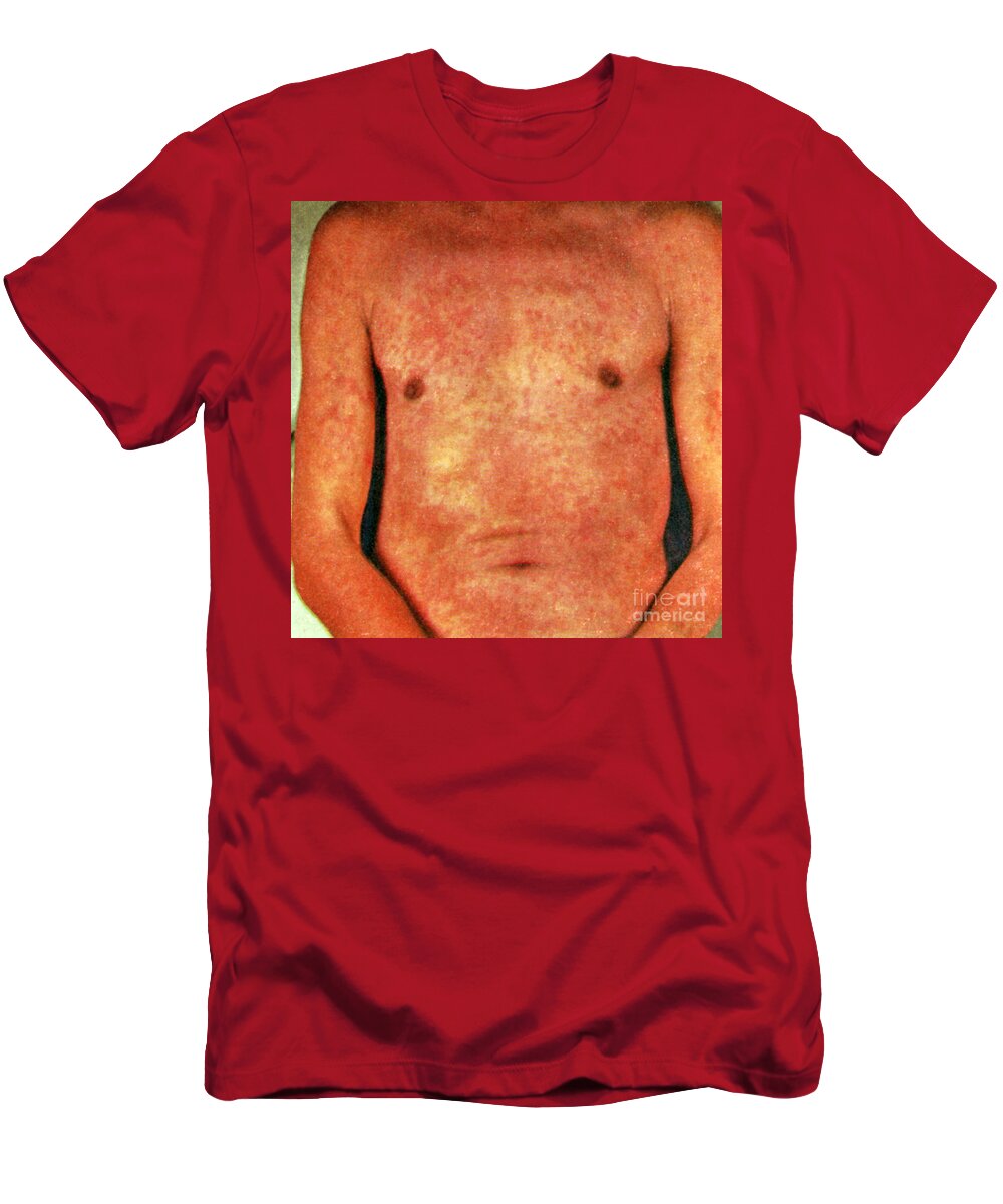Skin T-Shirt featuring the photograph Miliaria by Science Source