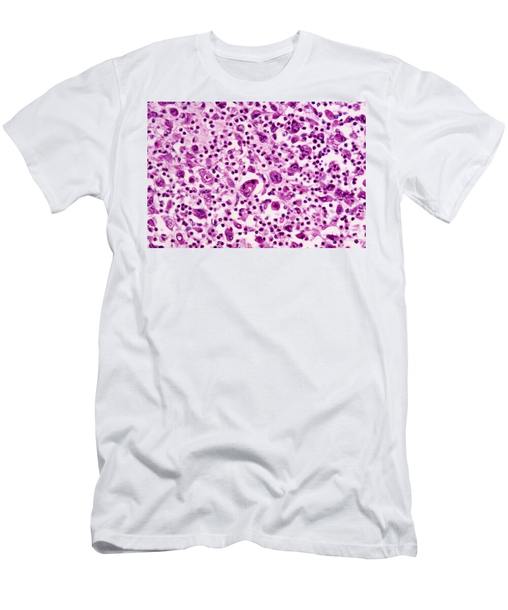 Abnormal T-Shirt featuring the photograph Giant-cell Carcinoma Of The Lung, Lm by Michael Abbey