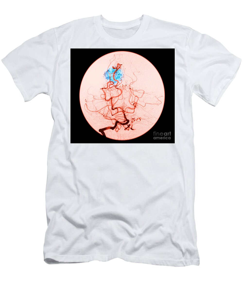 Abnormal Cerebral Angiogram T-Shirt featuring the photograph Occipital Lobe Avm #1 by Medical Body Scans