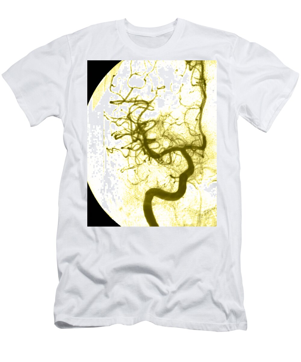 Angiogram T-Shirt featuring the photograph Cerebral Angiogram #7 by Medical Body Scans