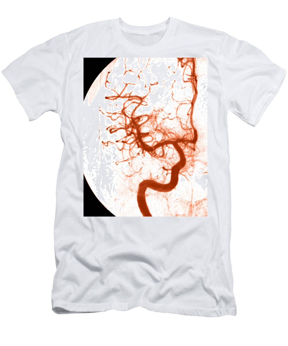 Angiogram T-Shirt featuring the photograph Cerebral Angiogram #9 by Medical Body Scans