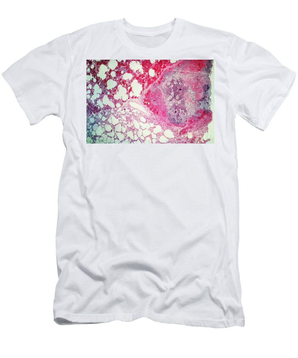 Light Micrograph T-Shirt featuring the photograph Lm Of Leprosy by Science Source