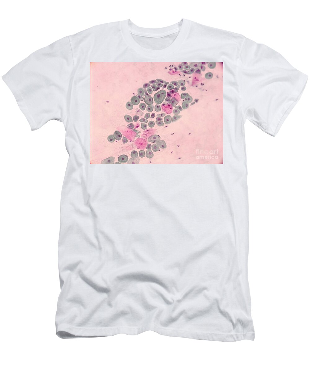 Medical T-Shirt featuring the photograph Pap Smear, Cancer by Science Source