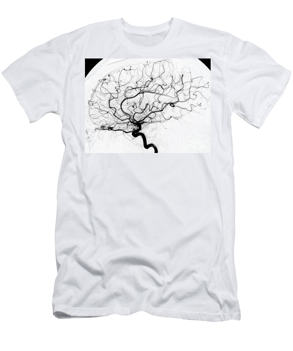 Cerebral Angiogram T-Shirt featuring the photograph Dural Arterial Venous Fistula, Angiogram by Living Art Enterprises