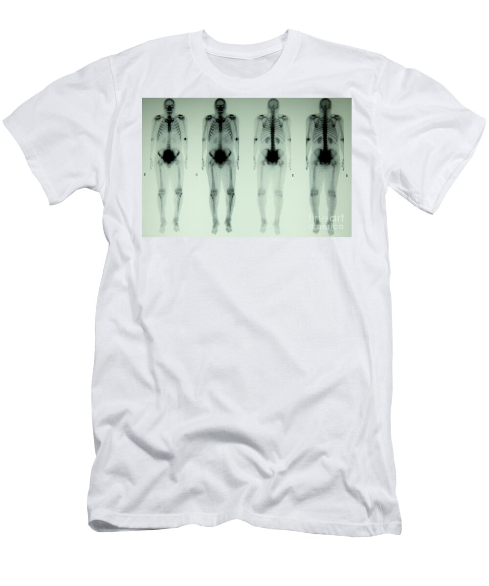 Nuclear Bone Scan T-Shirt featuring the photograph Nuclear Bone Scan by Inga Spence