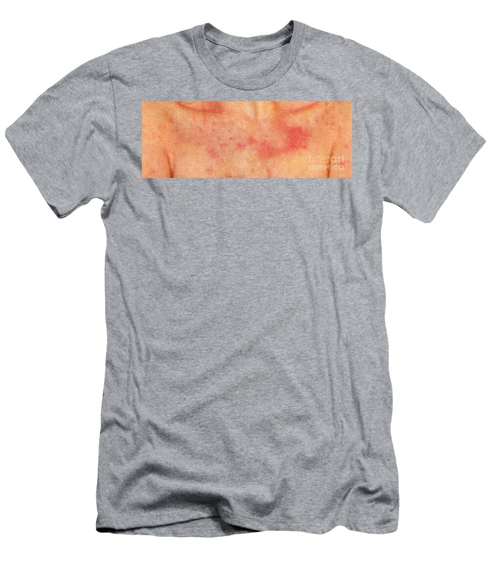 Psoriasis Chest T-Shirt featuring the photograph Acute Psoriasis by Science Source