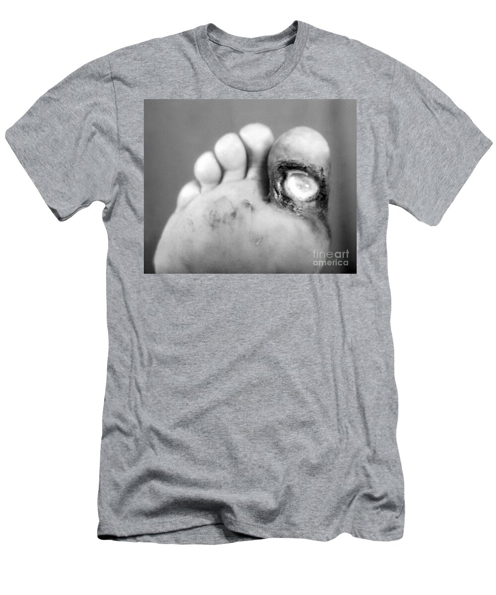 Bacterial T-Shirt featuring the photograph Syphilis Ulcer by Science Source