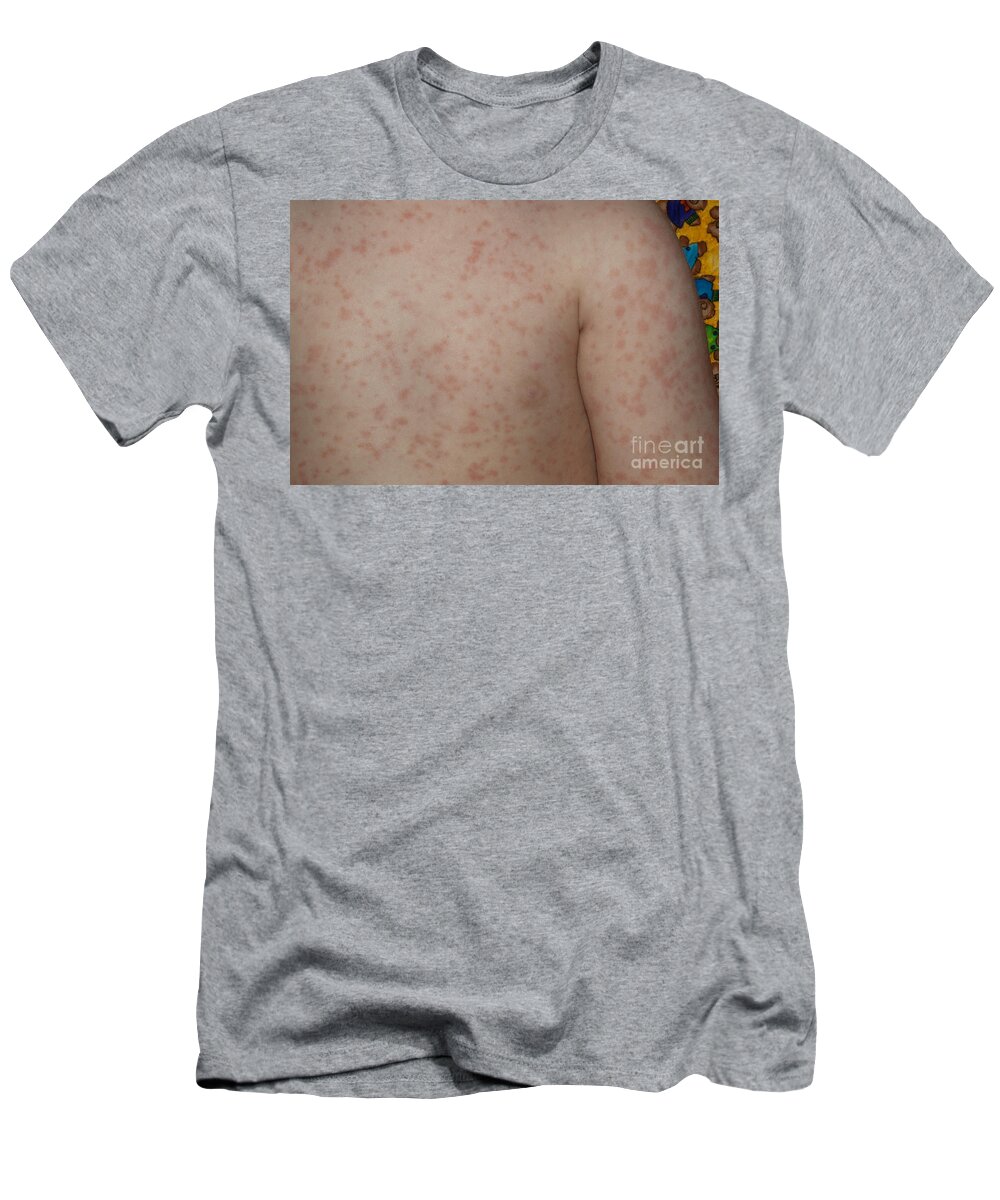 Disease T-Shirt featuring the photograph Fifth Disease by John Kaprielian